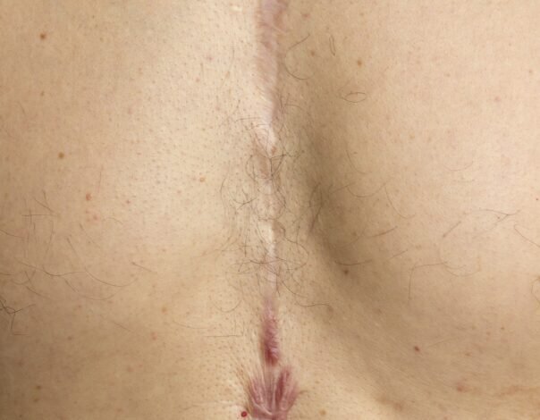 breast scarring