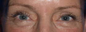 Upper Blepharoplasty (eyelid lift) Postop