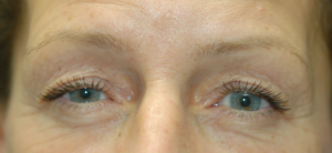 Upper Blepharoplasty (eyelid lift) preop