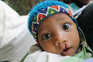 cute baby with a cleft lip