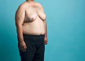 gynecomastia model