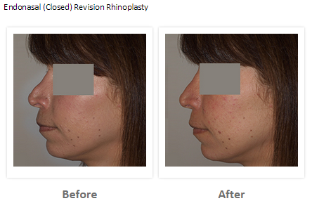Revision Rhinoplasty