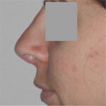 Rhinoplasty Series Part 2 Facts About Rhinoplasty