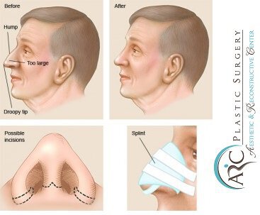 rhinoplastyinmiami