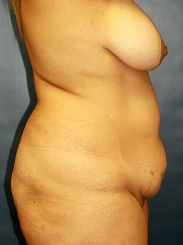 Abdominoplasty Before & After Image