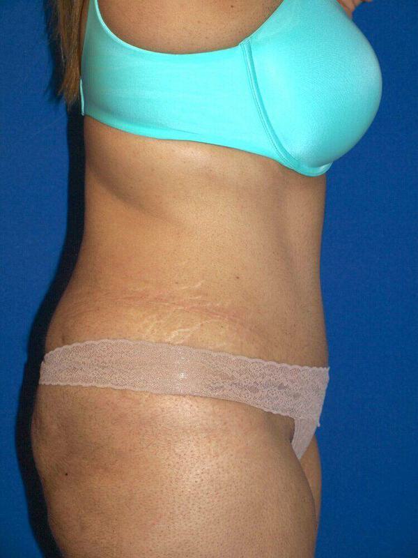 Abdominoplasty Before & After Image