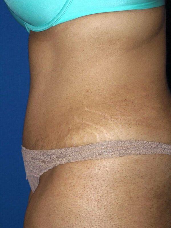 Abdominoplasty Before & After Image