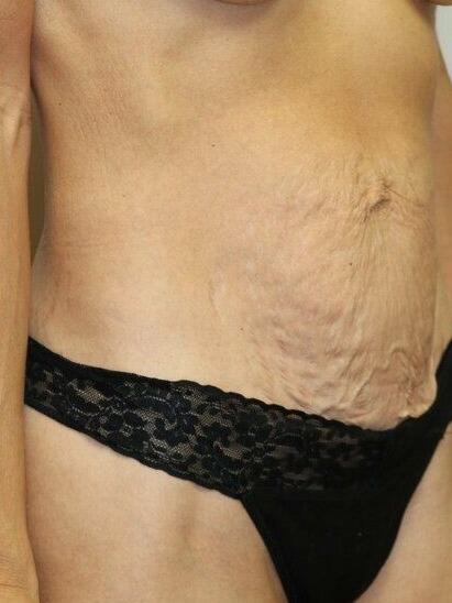 Abdominoplasty Before & After Image