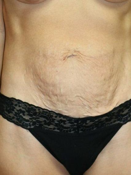 Abdominoplasty Before & After Image