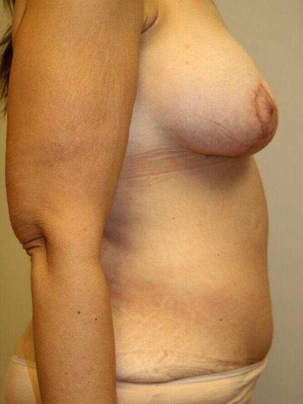 Abdominoplasty Before & After Image