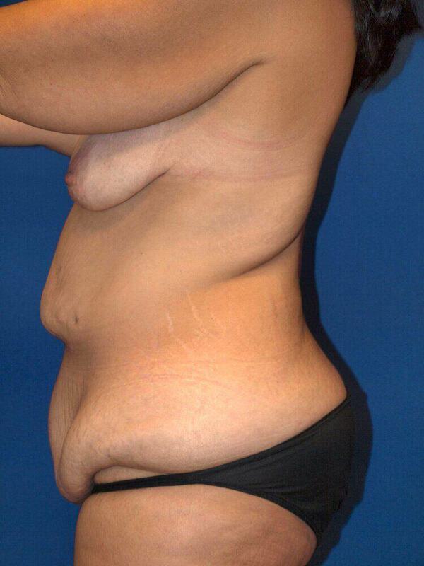 Abdominoplasty Before & After Image