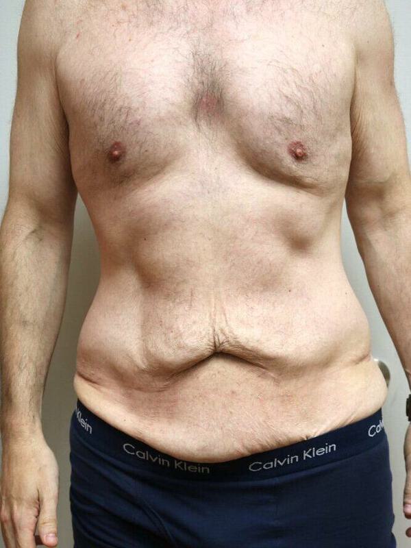 Abdominoplasty Before & After Image