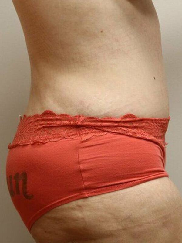 Abdominoplasty Before & After Image