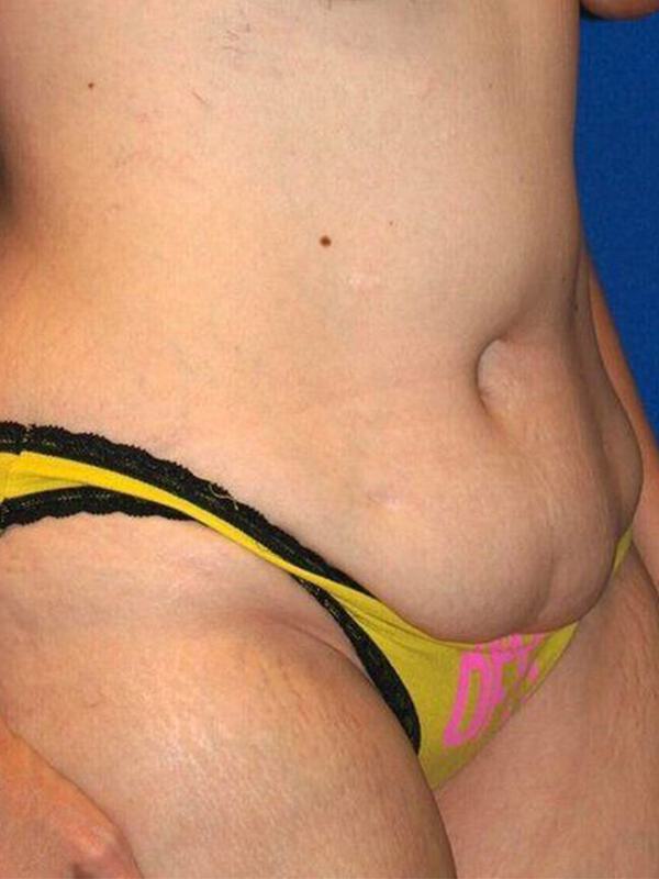 Abdominoplasty Before & After Image