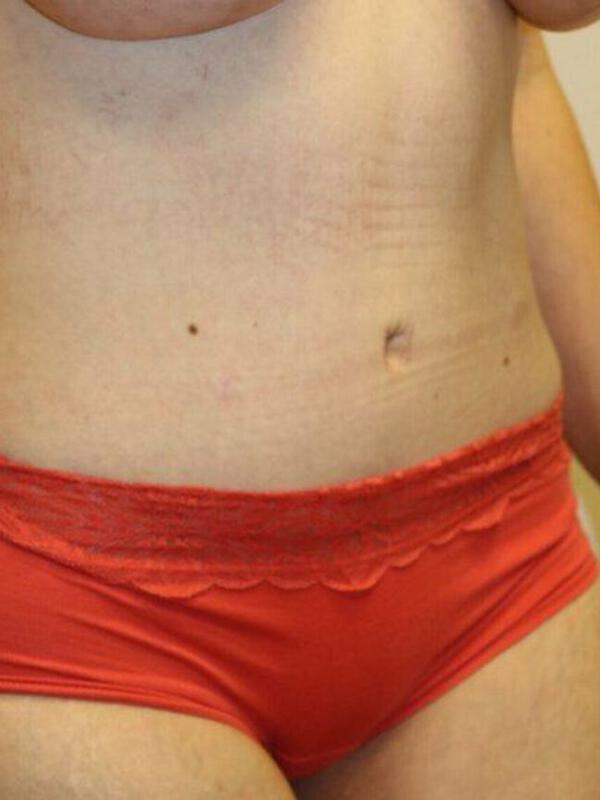 Abdominoplasty Before & After Image