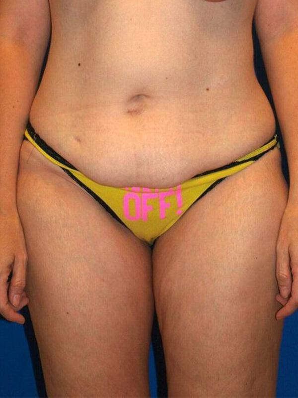 Abdominoplasty Before & After Image