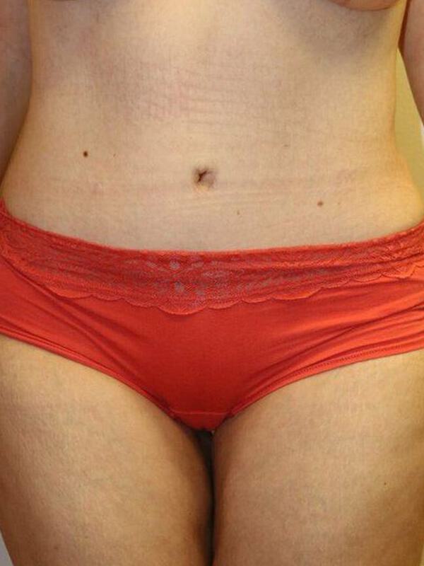 Abdominoplasty Before & After Image