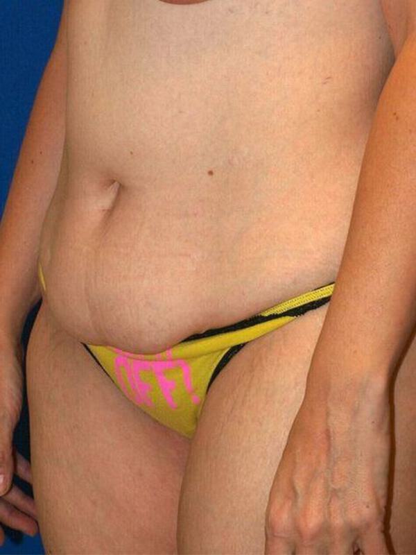 Abdominoplasty Before & After Image