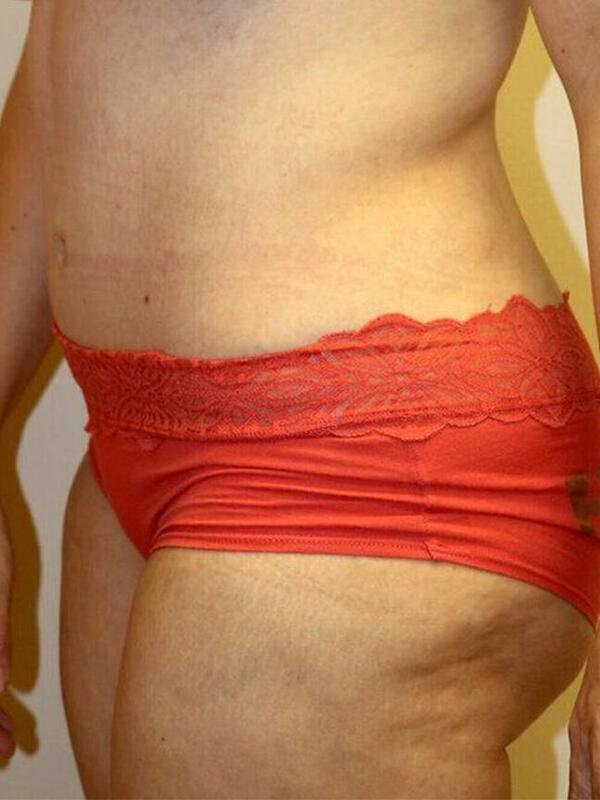 Abdominoplasty Before & After Image