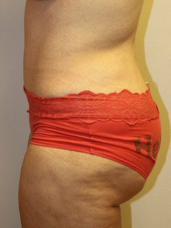 Abdominoplasty Before & After Image