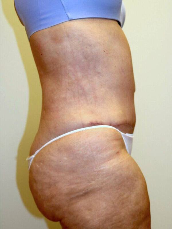 Abdominoplasty Before & After Image