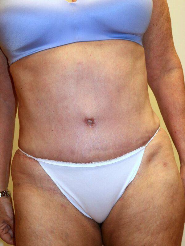 Abdominoplasty Before & After Image