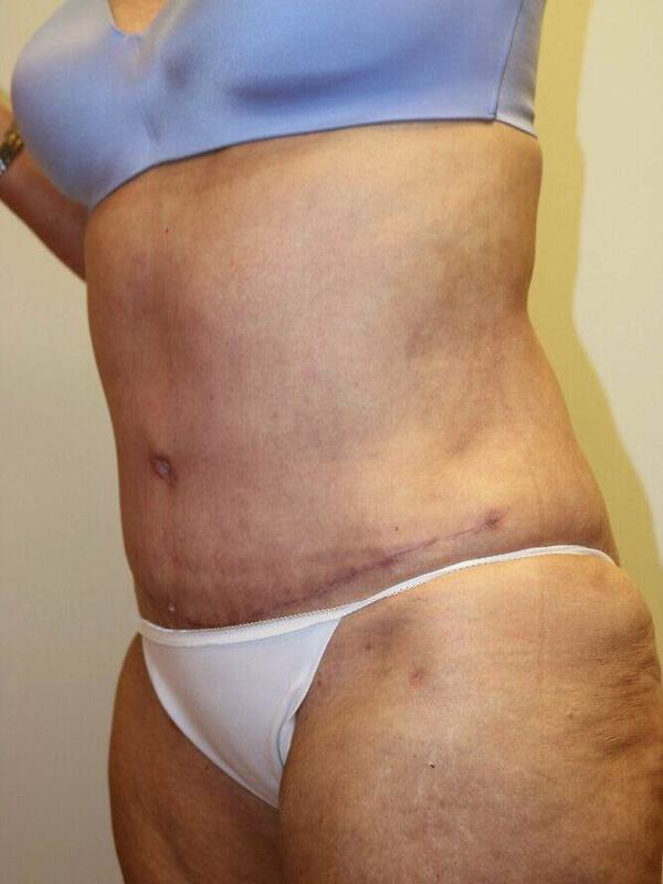 Abdominoplasty Before & After Image