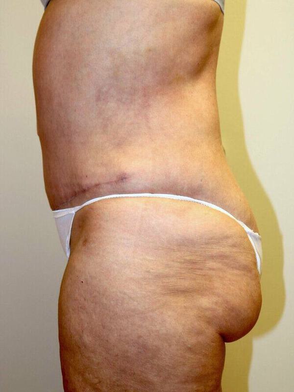 Abdominoplasty Before & After Image