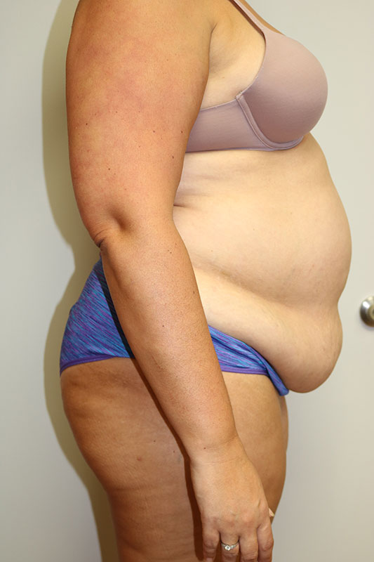 Abdominoplasty Before & After Image