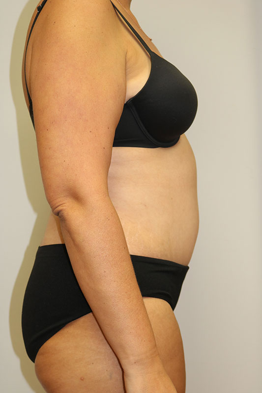 Abdominoplasty Before & After Image