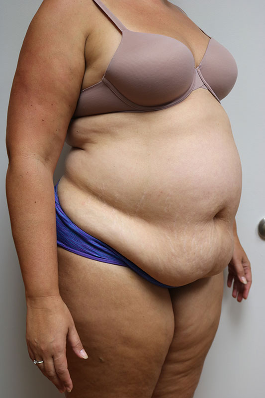 Abdominoplasty Before & After Image