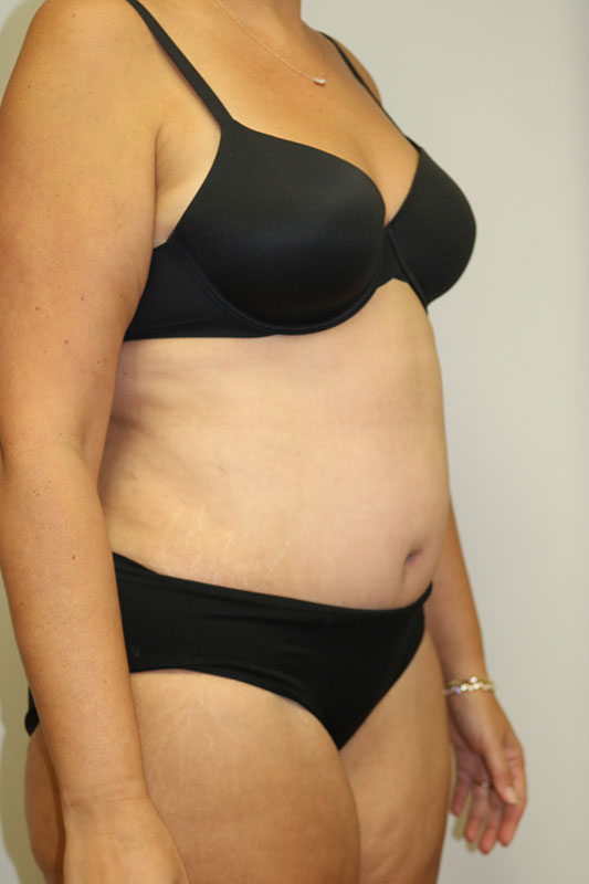 Abdominoplasty Before & After Image