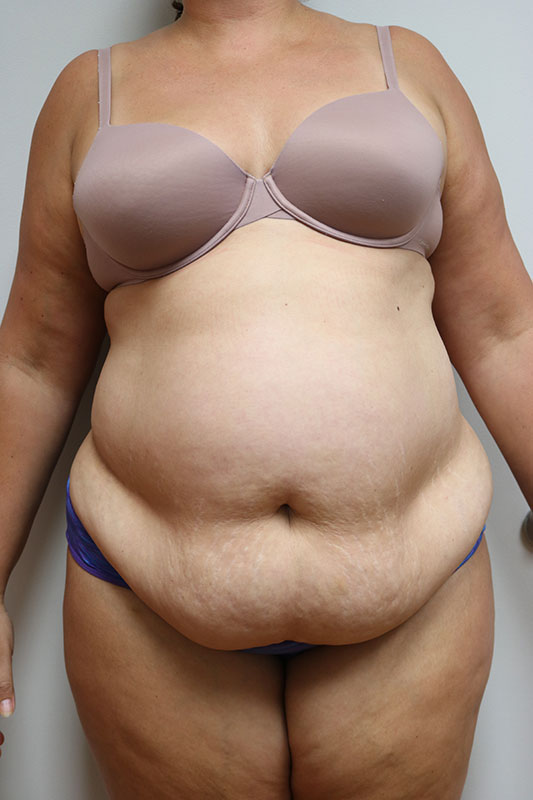 Abdominoplasty Before & After Image