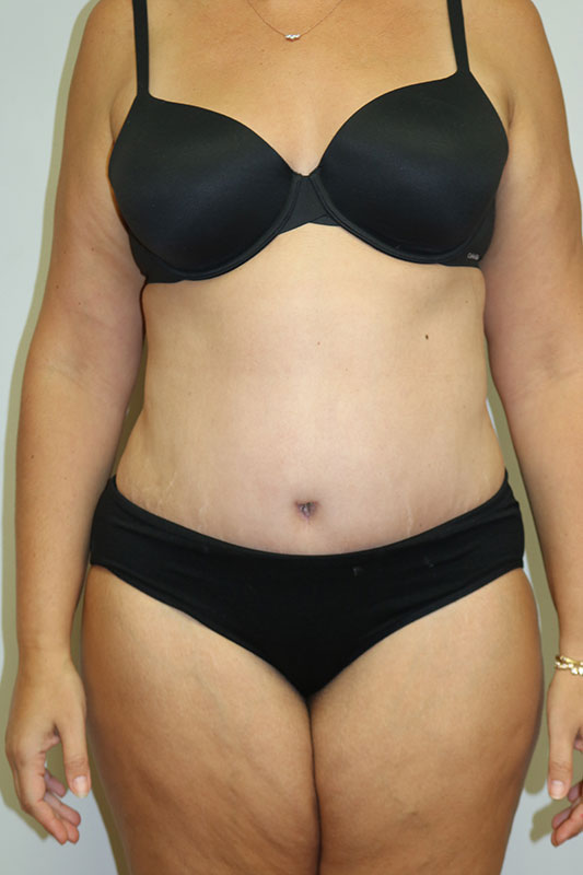 Abdominoplasty Before & After Image