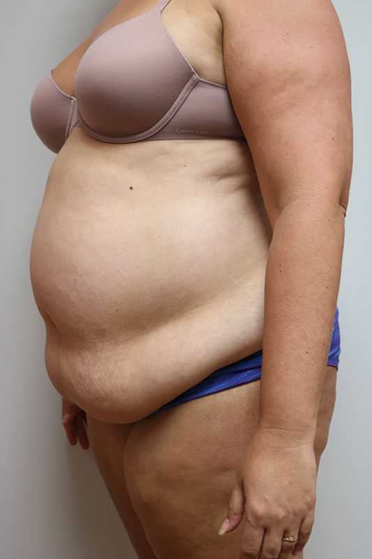 Abdominoplasty Before & After Image