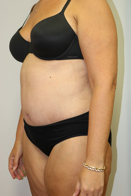 Abdominoplasty Before & After Image