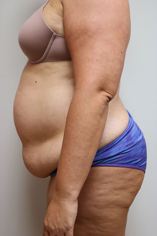 Abdominoplasty Before & After Image