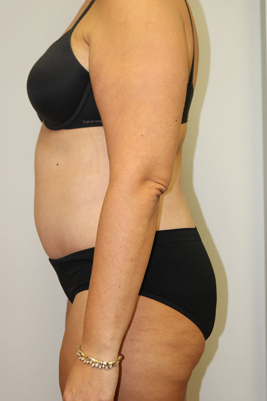 Abdominoplasty Before & After Image