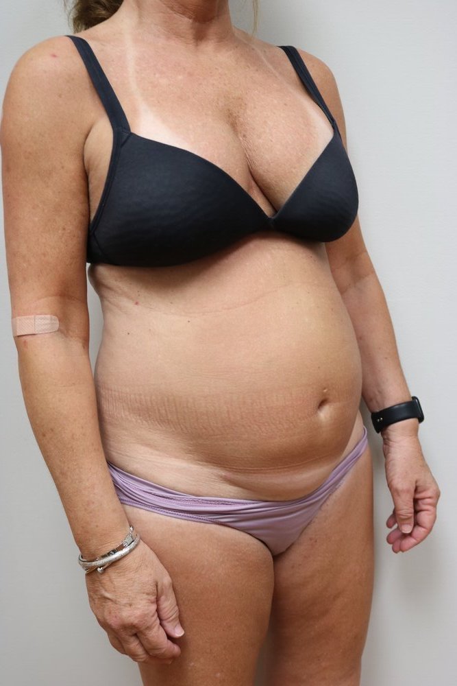 Abdominoplasty Before & After