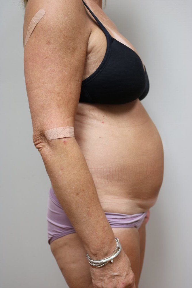 Abdominoplasty Before & After