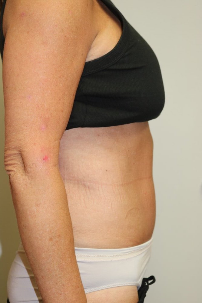 Abdominoplasty Before & After