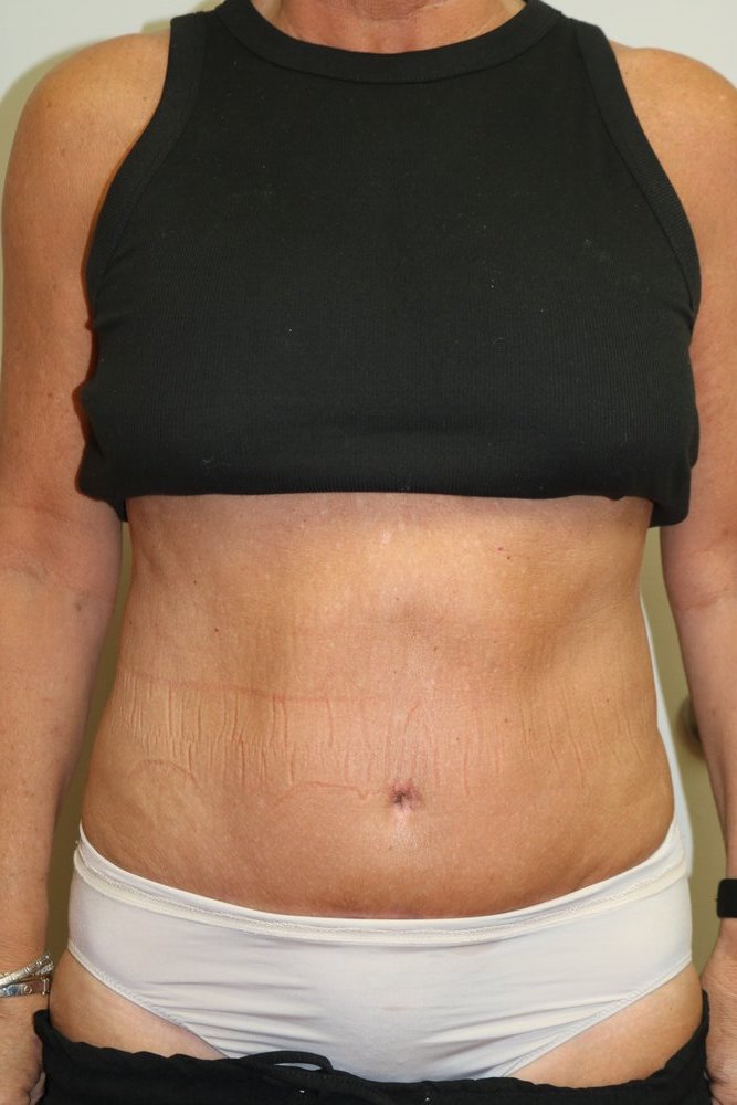 Abdominoplasty Before & After