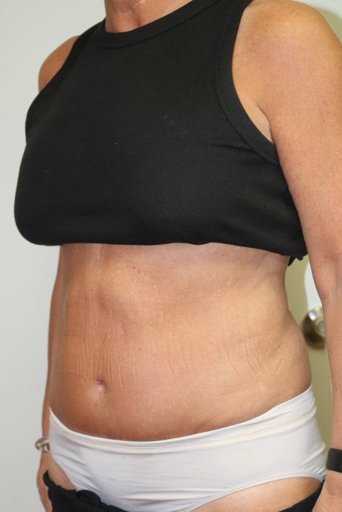 Abdominoplasty Before & After