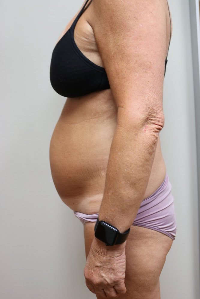 Abdominoplasty Before & After