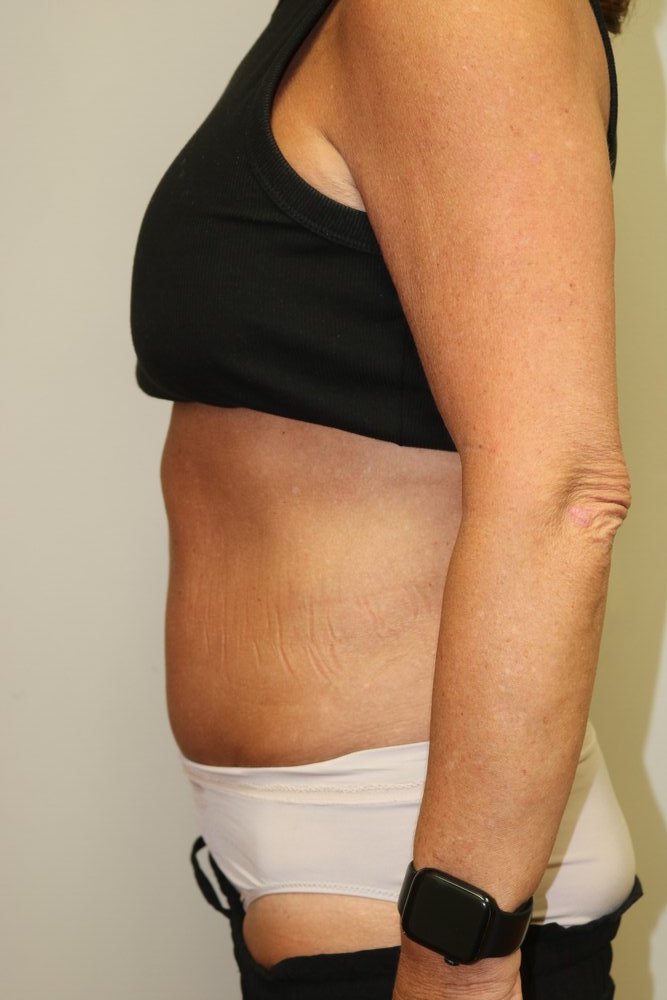 Abdominoplasty Before & After