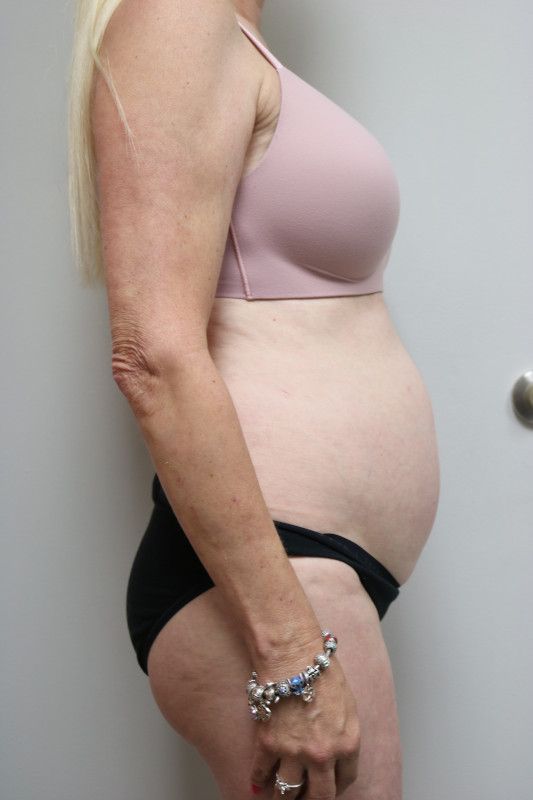 Abdominoplasty Before & After