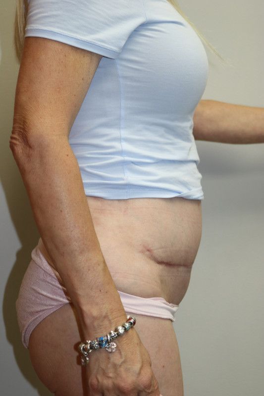 Abdominoplasty Before & After
