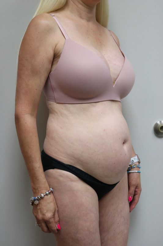 Abdominoplasty Before & After