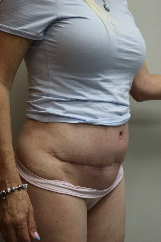Abdominoplasty Before & After