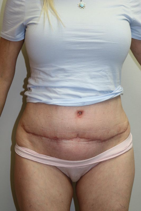 Abdominoplasty Before & After